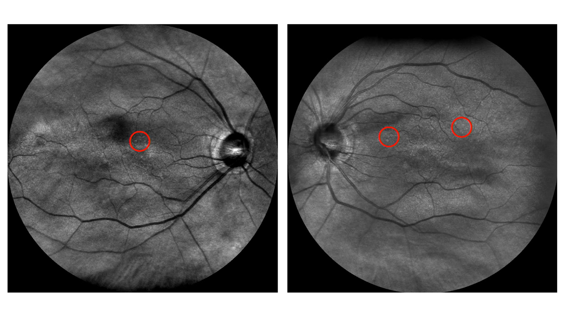Sichtkontakte Vortrag Optometrische Praxis: Untersuchungsergebnisse richtig einschätzen